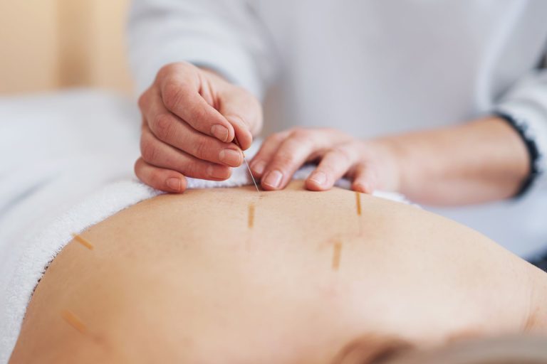 Dry Needling Palm Beach
